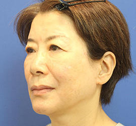 60代女性のヒアルロン酸骨格リフト After 症例写真