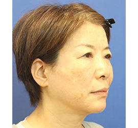 60代女性のヒアルロン酸骨格リフト After 症例写真