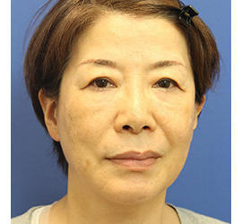 60代女性のヒアルロン酸骨格リフト Before 症例写真