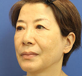 60代女性のヒアルロン酸骨格リフト Before 症例写真