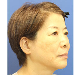 60代女性のヒアルロン酸骨格リフト Before 症例写真