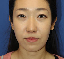 20代女性の3Dリポアイリフト  After 症例写真