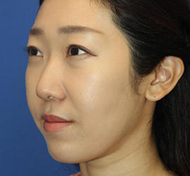 20代女性のエラ・アゴ・小顔 After 症例写真