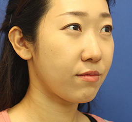 20代女性の3Dリポアイリフト  After 症例写真