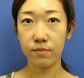 20代女性の3Dリポアイリフト  Before 症例写真