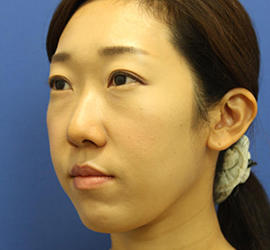 20代女性のエラ・アゴ・小顔 Before 症例写真