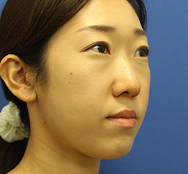 20代女性の3Dリポアイリフト  Before 症例写真
