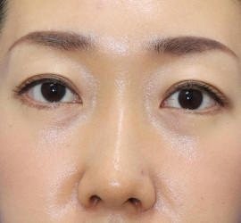 30代女性の二重整形・目元の整形 After 症例写真