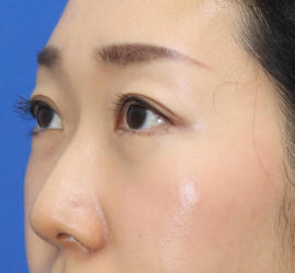 30代女性のタレ目・でか目形成 After 症例写真