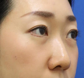 30代女性のタレ目・でか目形成 After 症例写真