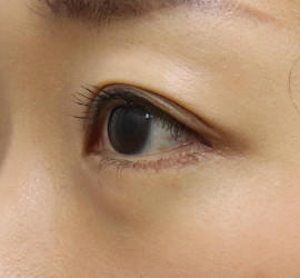 30代女性のタレ目・でか目形成 After 症例写真