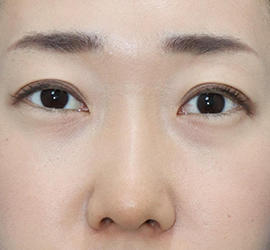 30代女性の二重整形・目元の整形 Before 症例写真