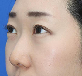 30代女性のタレ目・でか目形成 Before 症例写真