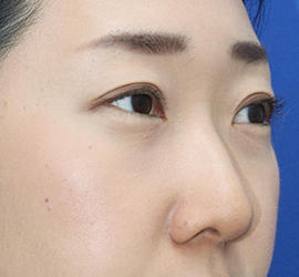 30代女性のタレ目・でか目形成 Before 症例写真