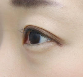 30代女性のタレ目・でか目形成 Before 症例写真