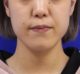 20代女性の顔の脂肪吸引  After 症例写真