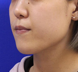 20代女性の顔の脂肪吸引  After 症例写真