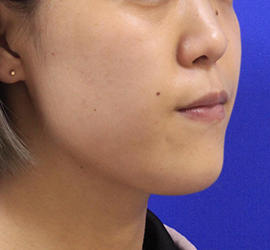 20代女性の顔の脂肪吸引 After 症例写真