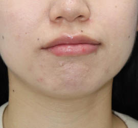20代女性の小林式ニキビ治療法 After 症例写真