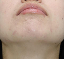 20代女性の小林式ニキビ治療法 After 症例写真
