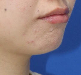 20代女性の小林式ニキビ治療法 After 症例写真