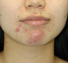 20代女性の小林式ニキビ治療法 Before 症例写真