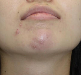 20代女性の小林式ニキビ治療法 Before 症例写真