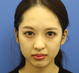 10代女性の目つき矯正 After 症例写真