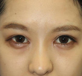 10代女性の目つき矯正 After 症例写真