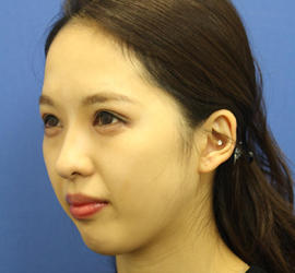 10代女性の目つき矯正 After 症例写真