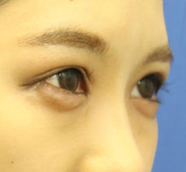 10代女性の目つき矯正 After 症例写真