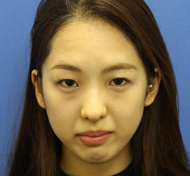 10代女性の目つき矯正 Before 症例写真