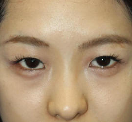 10代女性の目つき矯正 Before 症例写真