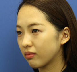 10代女性の目つき矯正 Before 症例写真