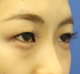 10代女性の目つき矯正 Before 症例写真