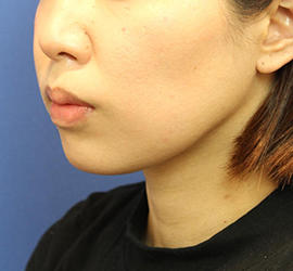 20代女性の顔の脂肪吸引  After 症例写真