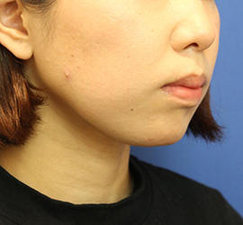 20代女性の顔の脂肪吸引 After 症例写真