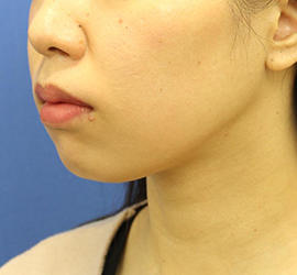 20代女性の顔の脂肪吸引  Before 症例写真