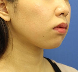 20代女性の顔の脂肪吸引 Before 症例写真