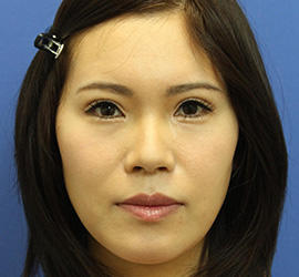 30代女性の全切開二重まぶた法 After 症例写真