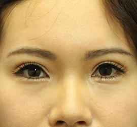 30代女性の全切開二重まぶた法 After 症例写真