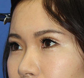 30代女性の全切開二重まぶた法 After 症例写真