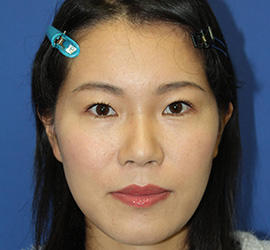 30代女性の全切開二重まぶた法 Before 症例写真