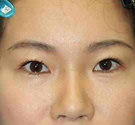 30代女性の全切開二重まぶた法 Before 症例写真