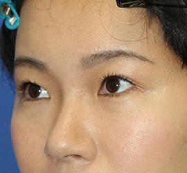 30代女性の全切開二重まぶた法 Before 症例写真