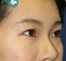 30代女性の全切開二重まぶた法 Before 症例写真