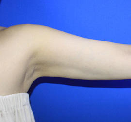 40代女性の脂肪吸引 After 症例写真