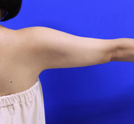 40代女性の脂肪吸引 After 症例写真