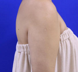 40代女性の脂肪吸引 After 症例写真