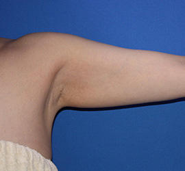 40代女性の脂肪吸引 Before 症例写真